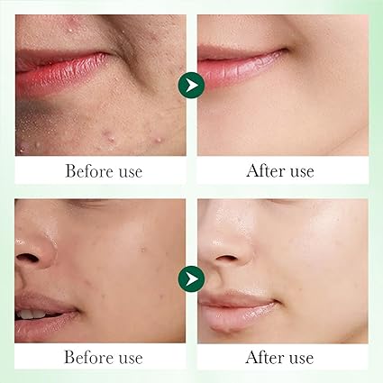 Limpieza facial Ácido Salicílico